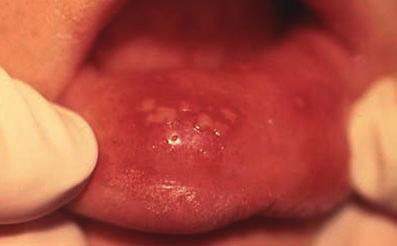 In the buccal or labial sulcus the ulcers may be linear (Fig 2). One to five ulcers usually occur at a time and they are approximately 5 mm in diameter.