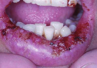 In a significant number of cases, oral mucosal lesions are the first presentation of the disease. Clinical features of pemphigus vulgaris The disorder typically presents first in older patients.