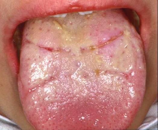 Tongue Irritation
