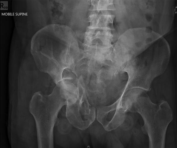 Pelvis and Hip Pelvic Bones Iliopsoas Joint Greater Trochanter