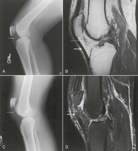 Medial and lateral epicondyle of the femur Patella Superior and inferior patella tendon Medial and lateral