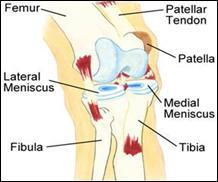 Meniscal Injuries Patient Education.