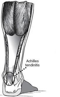 Achilles Tendonitis Acute and Chronic