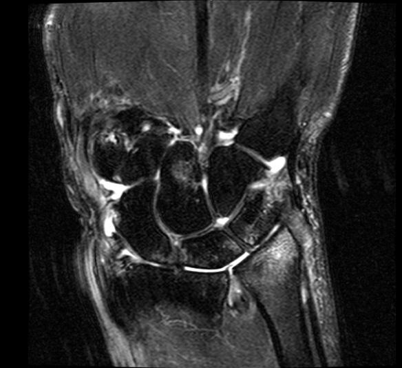 Contrast-enhanced MRI for bone marrow oedema Introduction Bone marrow oedema (BME) is one of the main features of rheumatoid arthritis (RA) that can be seen on magnetic resonance imaging (MRI).
