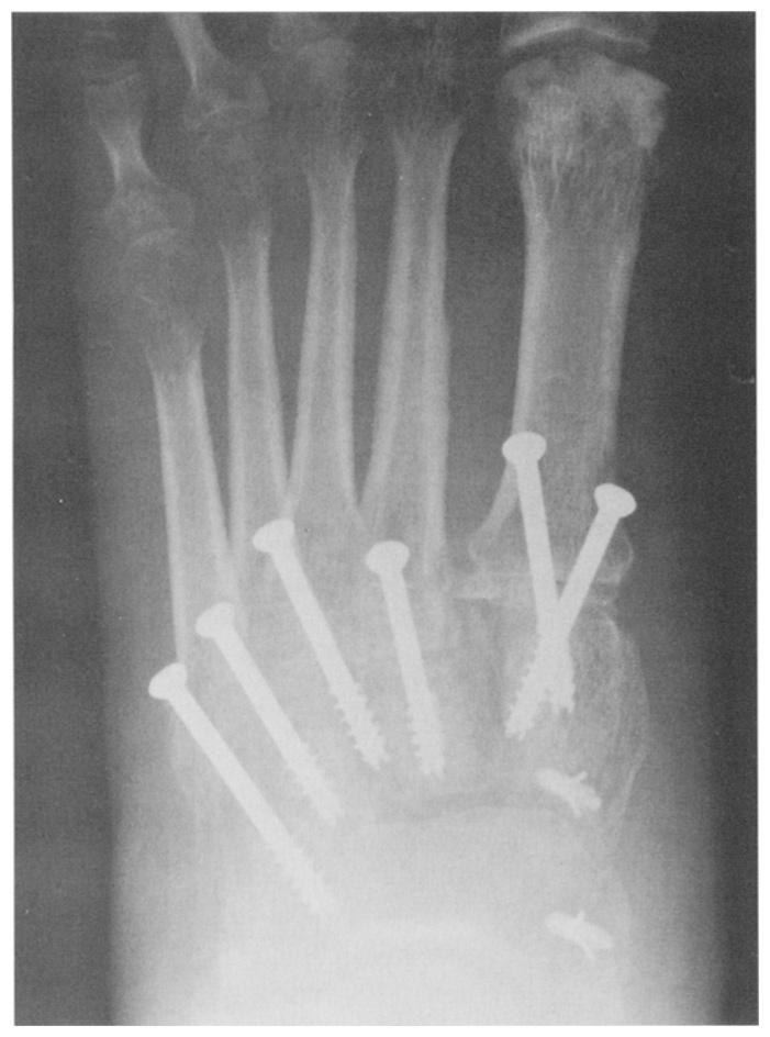 The screw heads were countersunk, and a small groove, created with a power bur, was placed on the dorsal aspect of the metatarsal bases approximately 1.5 to 2 em. from the tarsometatarsal joint.