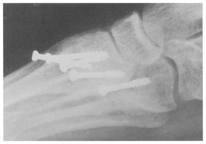 A partial Lisfranc complex fusion (medial three joints) was performed on four patients; a total joint complex fusion was performed on five patients. Intertarsal fusion was performed on four patients.