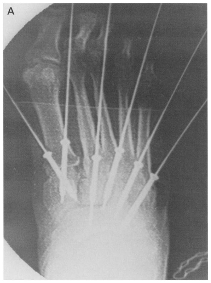 In addition to the Lisfranc fusion, two patients had posterior tibial tendon repairs, one patient had a medial column fusion, and four patients had intertarsal fusions.