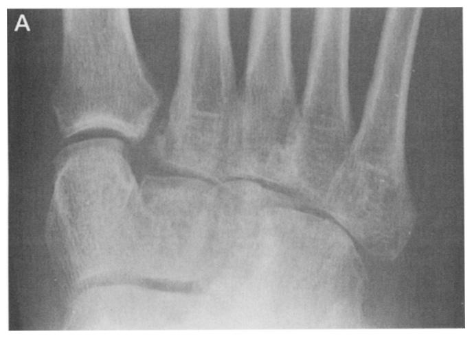 e, Incongruity of medial borders of second metatarsal and medial cuneiform. deformity.