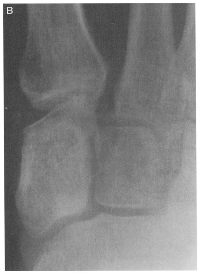 These patients can develop severe pain and deformity even when initial treatment is immediate. Successful fusion of the Lisfranc joint does not guarantee a good functional outcome (6,8,12-14).