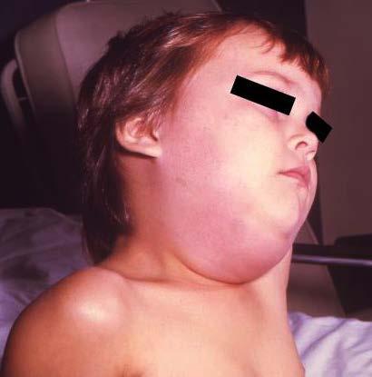 Mumps: Key Points Consider mumps in differential