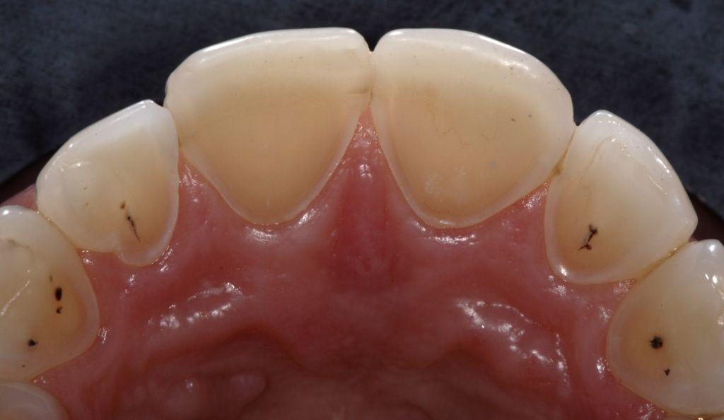 Fig. 1 A patient, 42 year old woman came complaining of tooth sensitivity.