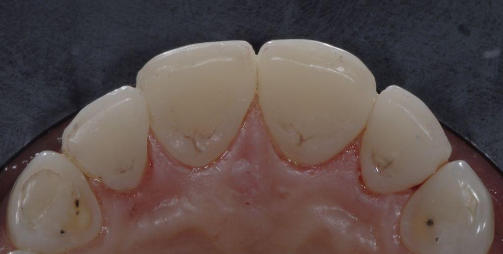 4 The composite veneers were sandblasted and then silanized for 2 minutes, after