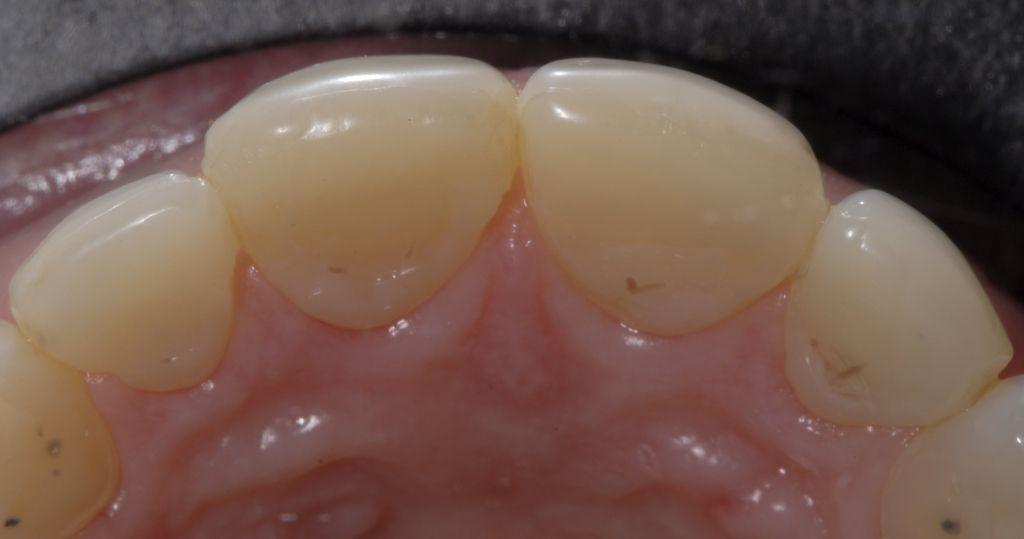 from the adjacent teeth. The tooth structure to be bonded was sandblasted using 27 micron Aluminum Oxide (CoJet, 3M Espe) to increase the surface area for greater retention and bond strength.