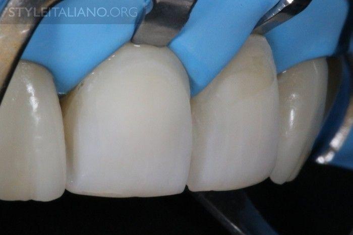 30 Img. 30 Precise rinsing and delicate air drying. In the AuthorÂ s experience: Both composite and ceramic veneers can result in excellent final esthetic outcomes, as seen in this case report.