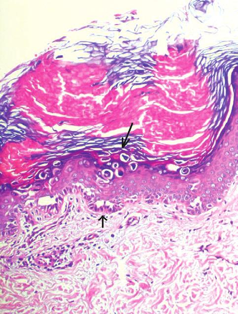 7 In 1997, Happle proposed a classification of segmental DD into two forms: Type 1 manifesting with distinct lesions of equal severity on