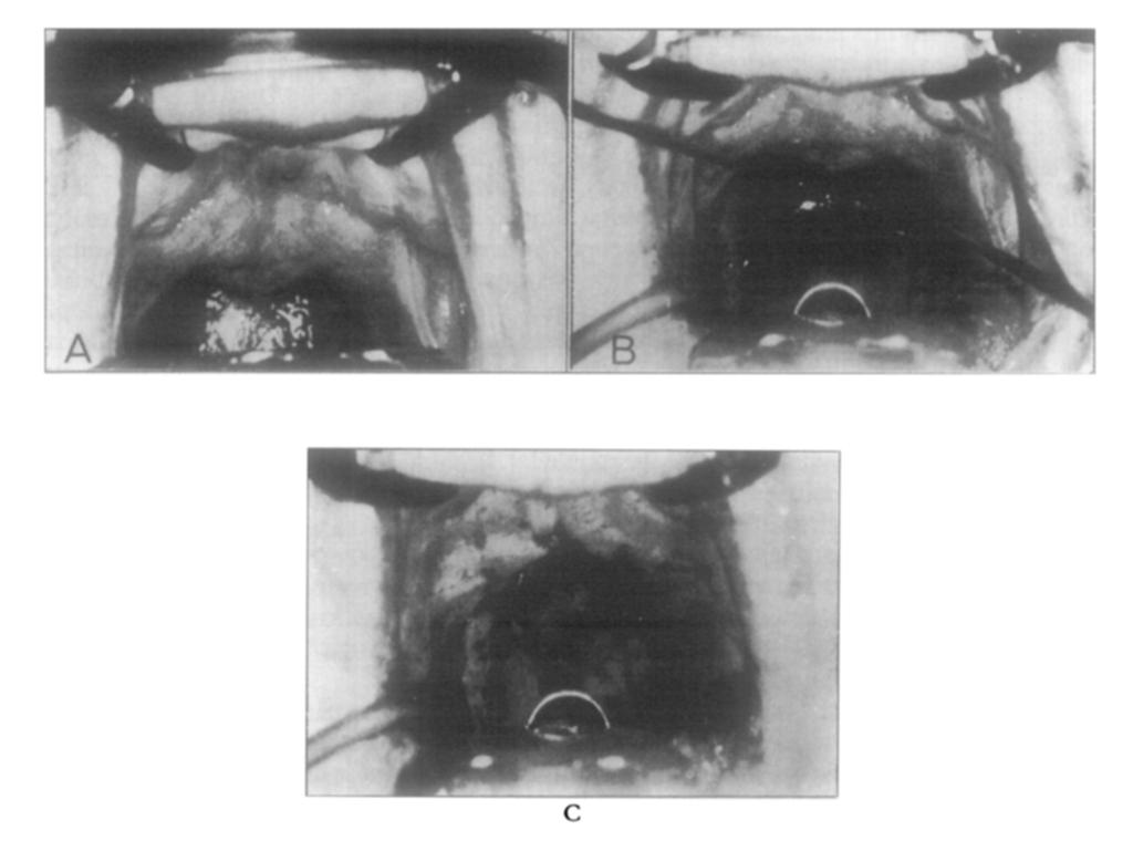 The interval between operation and fouow-up ranged from six months to nine years. All patients had been examined pre-operatively by a team consisting of an E.N.T. c FIG.