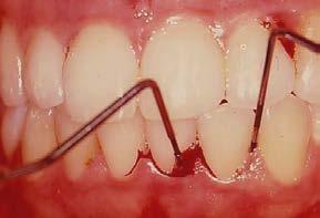 ODOLJARIO-INDIZE EDO HEMORRAGIA-INDIZE (OJ-I) Zundaketa periodontala egiterakoan, odola jario daiteke.