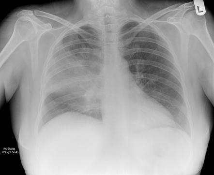 Stem 4: The patient goes onto develop a fever and the following x-ray whilst in hospital: Question 18: State the diagnosis. What predisposed him to this infection?