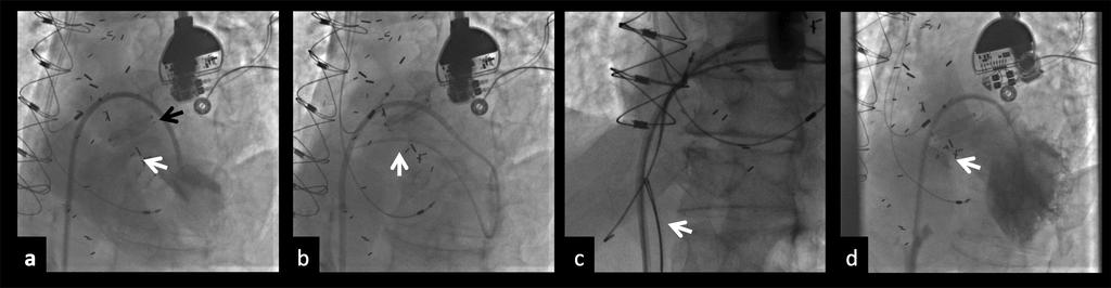 Figure 2. Angiographic images in case 1. (A) Left ventriculogram revealing ventricular septal defect (white arrow) and an On-X mechanical aortic valve (black arrow).