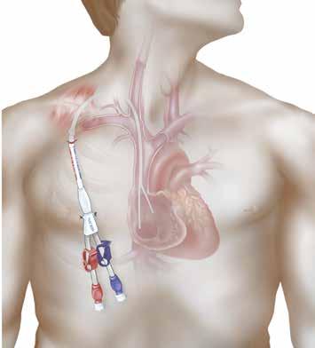 Arrow Cannon II Plus Optimal Placement, Minimal Risk. The Tip-first Advantage Start at the Heart with Arrow Cannon II Plus Catheter. It s engineered specifically for retrograde tunneling.