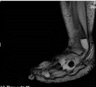 multiple lytic lesions in the right 1 st metatarsal bone (Figure 1).
