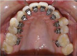 orthodontics, the irregular lingual dental anatomy and small interbracket distances make manual wire-bending difficult, especially in cases involving anterior