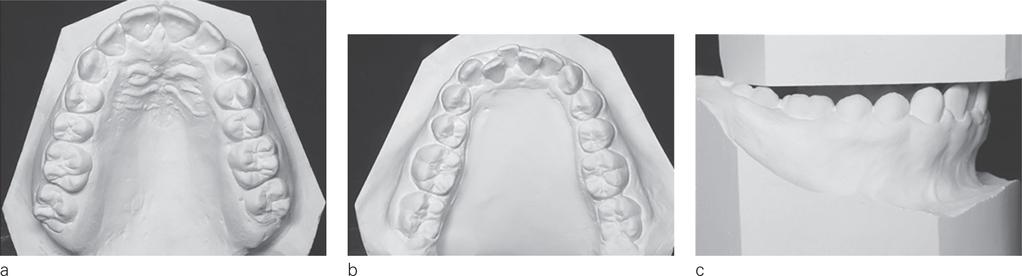 Figure 12 a, b, c: Occlusal maxillary and mandibular views
