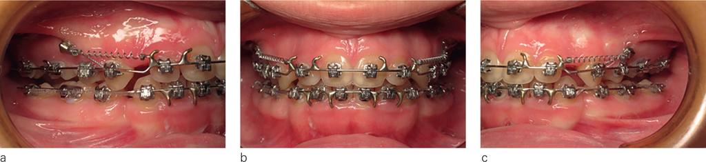 usually try to avoid this. Finishing will optimally adjust occlusion when malocclusion correction has been completed.