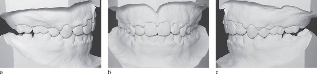 and left vestibular  Figure 25 a, b: Molds: occlusal,