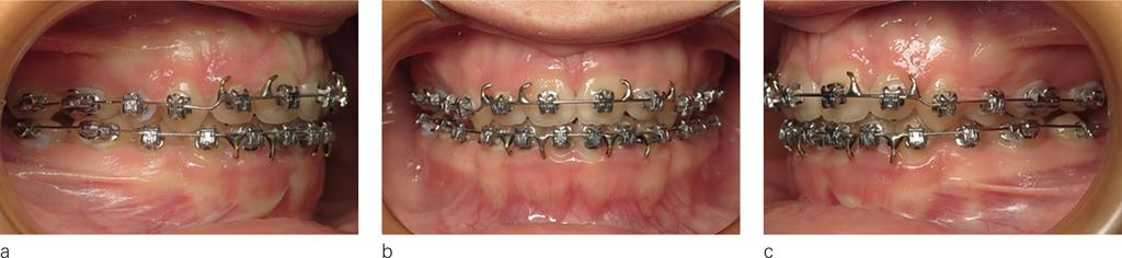 J. FAURE Treatment and finishing: April 2012 (14 years 3 months) - November 2014 (16 years 10 months) The patient was fitted with straight arch brackets with Roth prescription and built-in 10 and 15