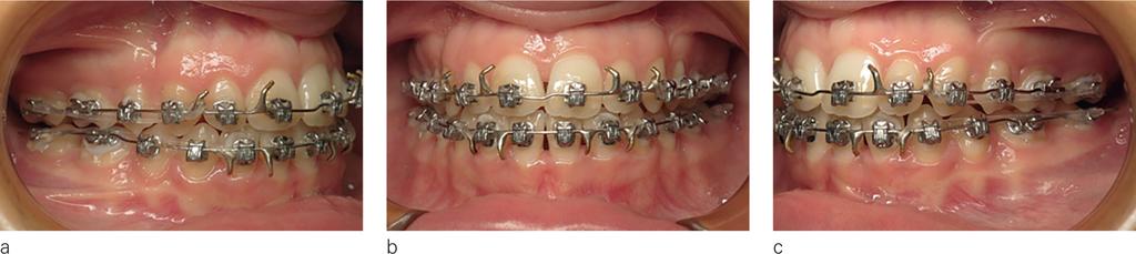 Multibracket treatment was begun in April 2012 (14 years 3 months) and finishing in March 2014 (16 years 2 months) (figs 57 and 60), with mainly 2 nd order interventions.