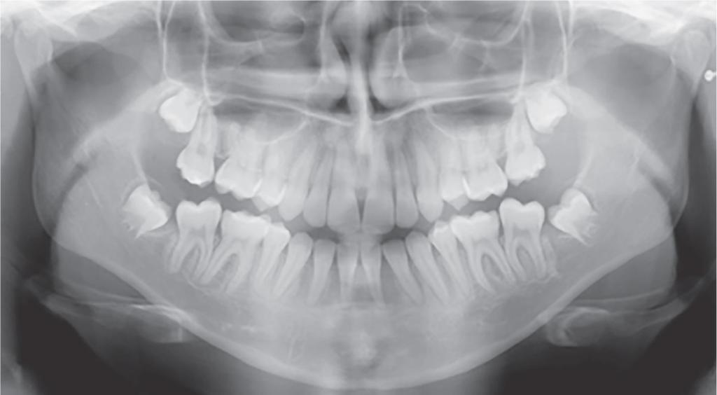 PROTOCOL FOR THE FINISHING STAGE Third-molar progression will be followed up (fig. 71).