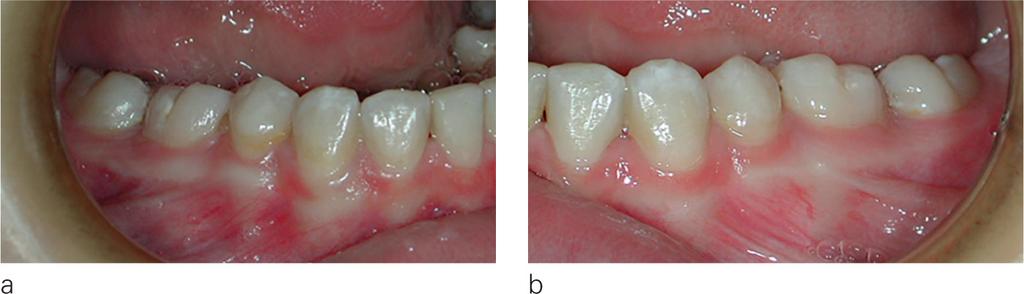 Figure 3 a, b: Intraoral views, canine region close-up, checking alignment,