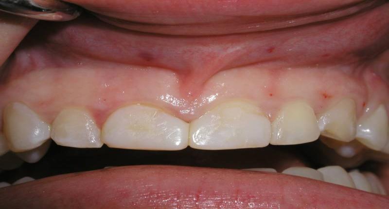 Indications for Banding Teeth that
