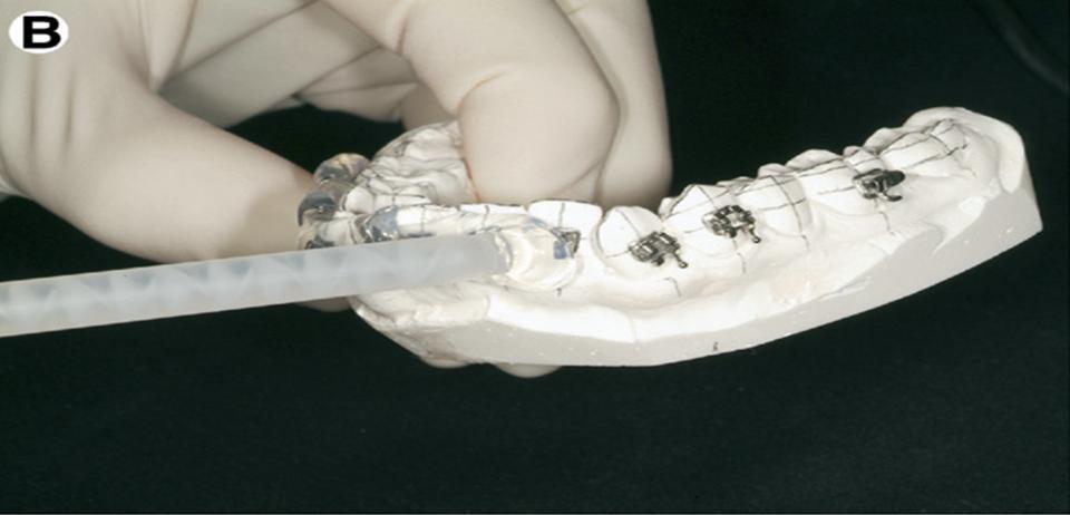 teeth and held in place with a fitted resin 2.