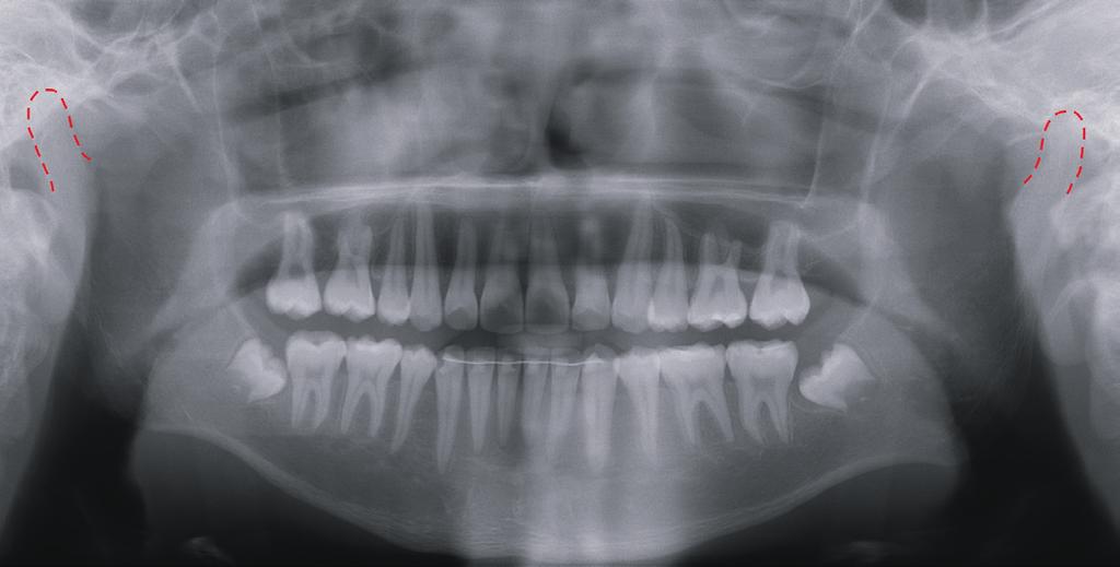 3: Post-treatment panoramic radiograph shows both condylar heads outlined in red. Clockwise rotation of the occlusal plane was related to correction of the deep curve of Spee.