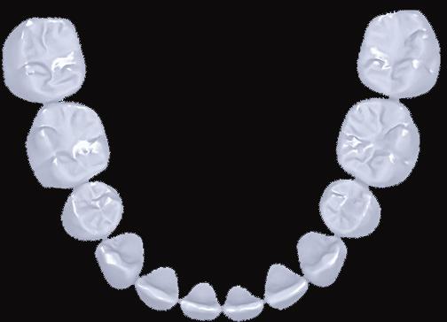 The superimposed maxillary (upper right) and mandibular (lower right) tracing show the retraction and extrusion of the