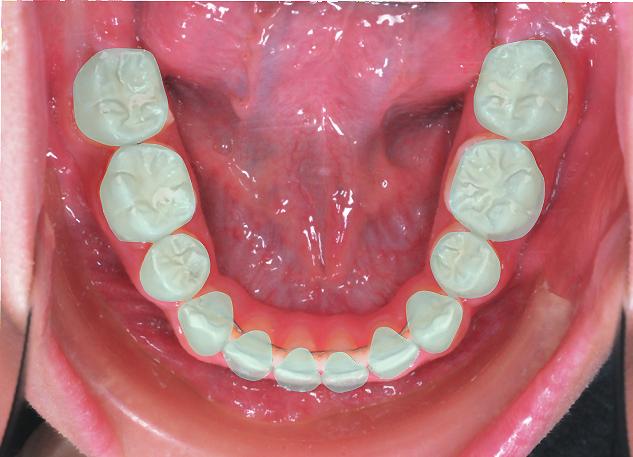 The combination of incisal retraction and anterior displacement of the E-Line resulted in decreased lip protrusion.