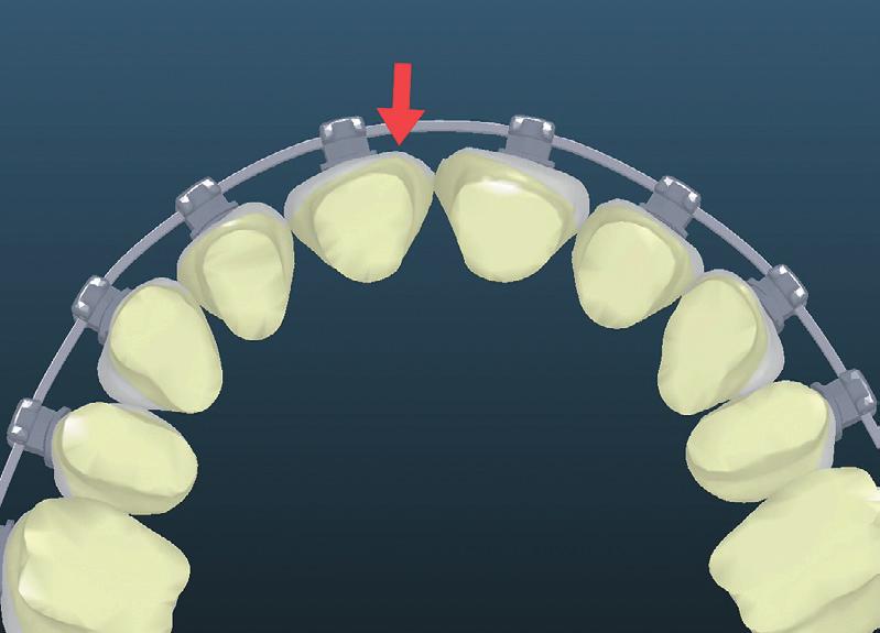 The specific mechanics required for this growing patient that required first premolar extractions was an addition 5. Thus, the overall torque over-correction was 0.
