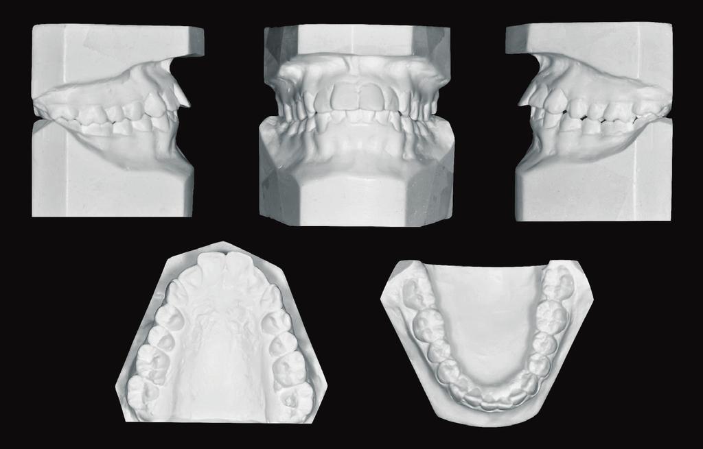 IJOI 48 iaoi CASE REPORT via bracket repositioning and detailing bends is required for a precise final alignment despite variations in tooth-surface morphology, manual errors in the direct bonding