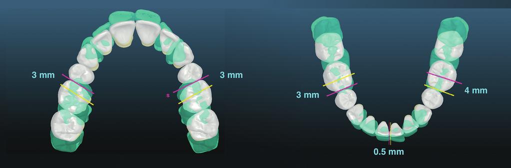 IJOI 48 iaoi CASE REPORT Digital Set-Up () Vertical: Upper: Extrude incisors mm Lower: Intrude incisors 2mm, and correct the curve of Spee Anterior overbite: Set to.