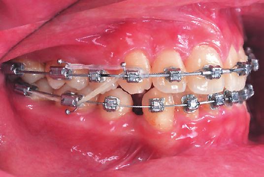 premolars, all