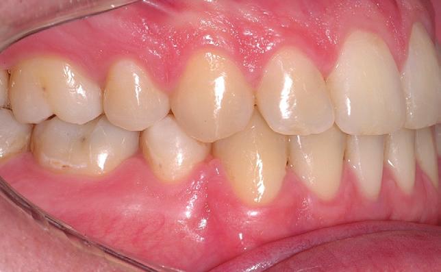 the arches as well as a Class I relationship for molars and canines.