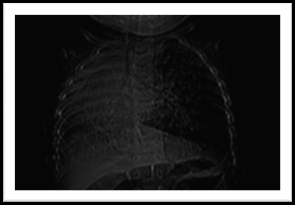 Fig1: Scanogram showing decreased right lung volume, trachea and cardia