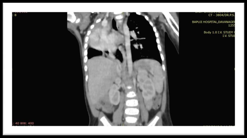 Fig 3: Coronal Reformatted CECT showing anamolous pulmonary venous drainage (scimitar vein)draining into IVC below diaphragm Fig 4: Axial