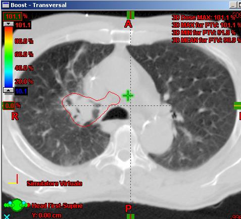 advanced NSCLC patients treated with