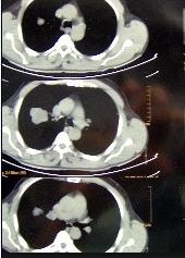 Methods and Materials:! From 2009 to 2013, patients with locally advanced lung cancer were treated at our institution undergoing to weekly thorax CT.