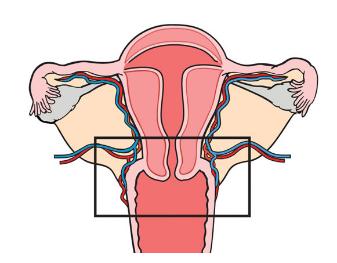 Trachelectomy Indications Women < 40 YO