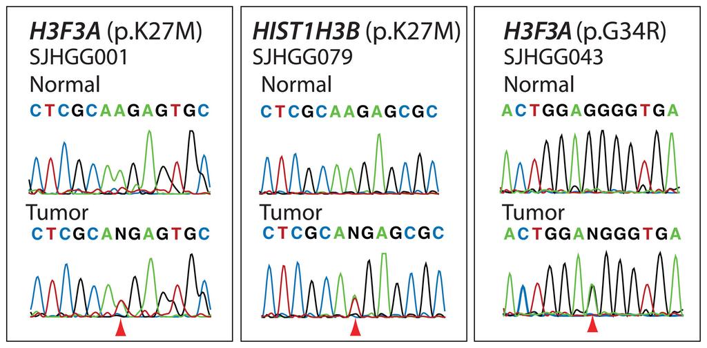 Wu et al. Page 5 Figure 1. Recurrent somatic mutations in H3F3A and HIST1H3B Sanger sequencing chromatograms showing representative H3F3A or HIST1H3B mutations encoding p.