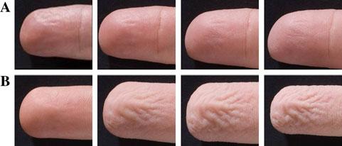 Clin Auton Res (2010) 20:249 253 251 Fig. 1 The photographs are taken from left to right at t = 0, 5, 15 and 30 min. a Patient with an abnormal result on finger wrinkling test.